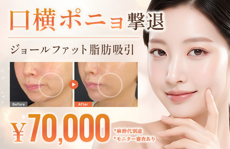 キャンペーン