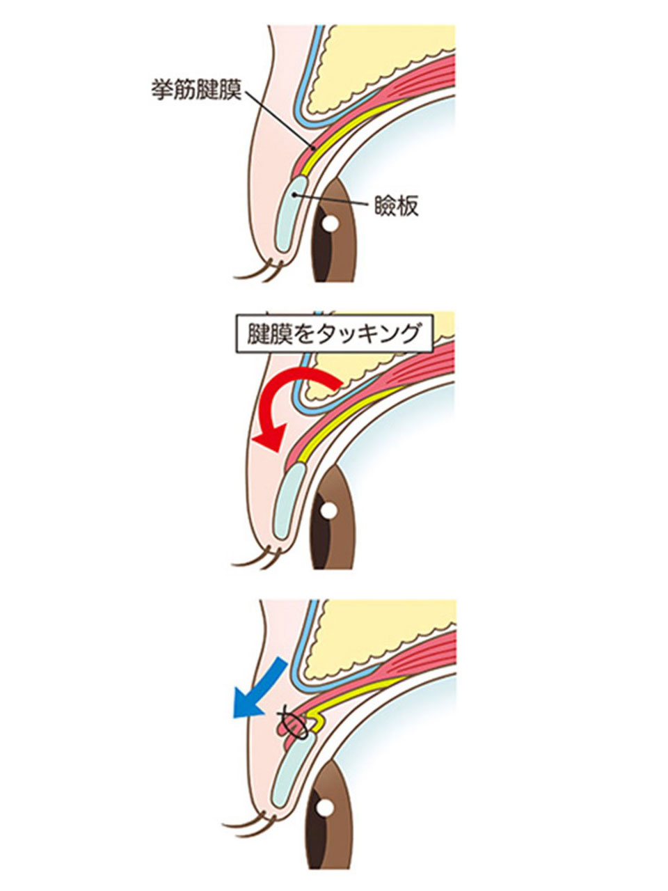 眼瞼下垂の挙筋腱膜タッキング