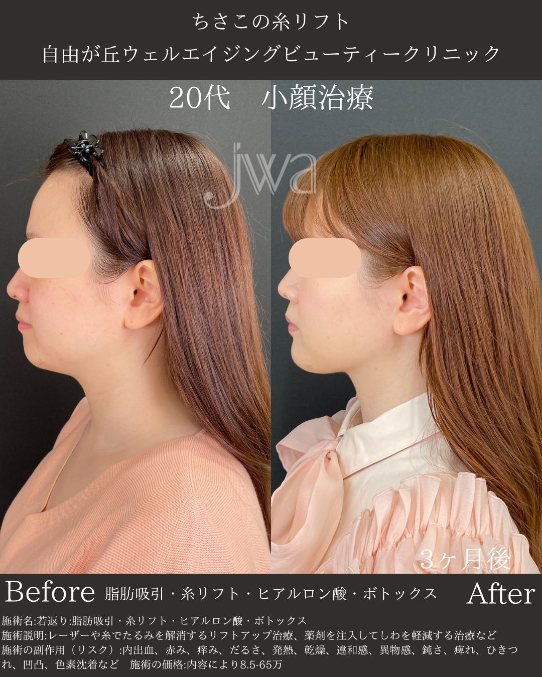糸リフト×脂肪吸引×ヒアルロン酸×ボトックス