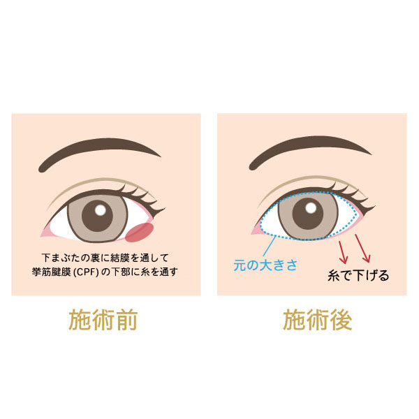 切らないたれ目形成術の説明