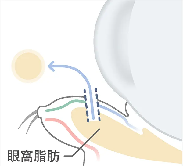 切らない目の下のクマ取り治療