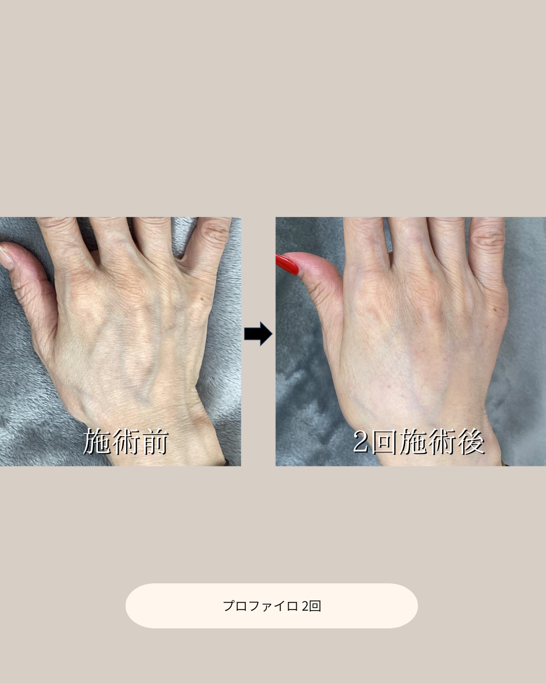プロファイロ症例1