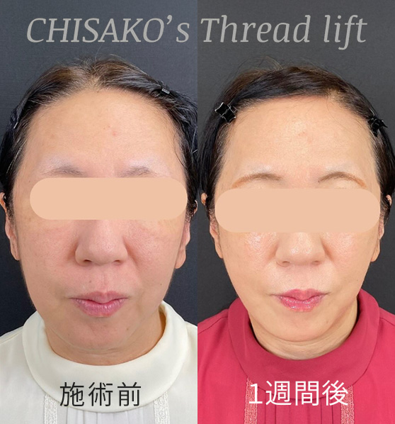 糸リフト(アルテミス)