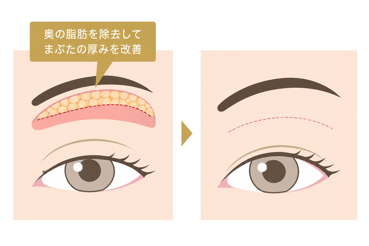 眼窩脂肪切除